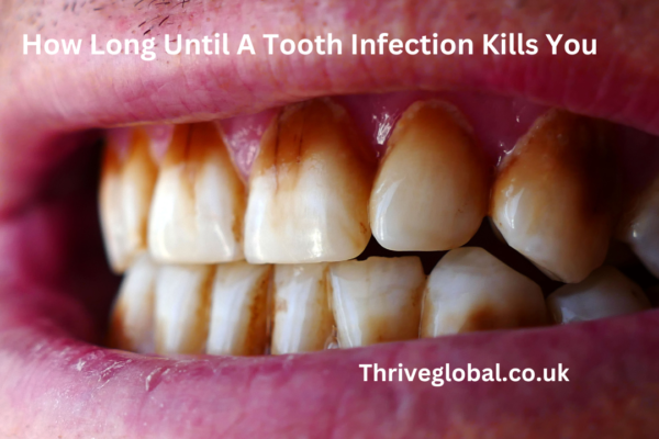 How Long Until A Tooth Infection Kills You